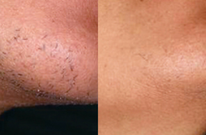 JOIN THE PAIN-FREE LASER HAIR REMOVAL REVOLUTION